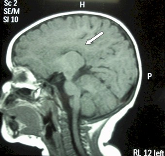 retraso_crecimiento_cerebral/resonancia_magnetica_cerebral