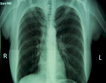 sindrome_Swyer-James/Rx_hiperclaridad_torax