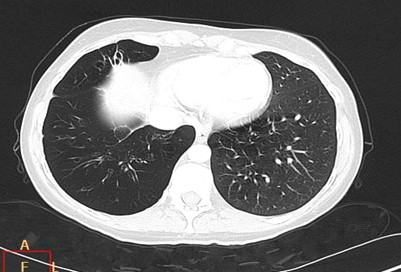 sindrome_Swyer-James/TAC_imagenes_radiolucidas_torax