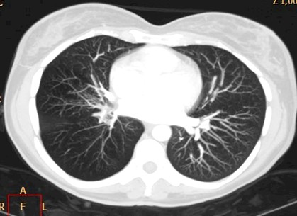 sindrome_Swyer-James/TAC_reconstruccion_MIP