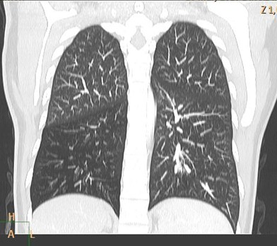 sindrome_Swyer-James/hiperclaridad_lobulo_inferior
