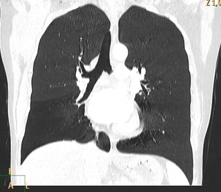 sindrome_Swyer-James/hiperclaridad_lobulo_medio