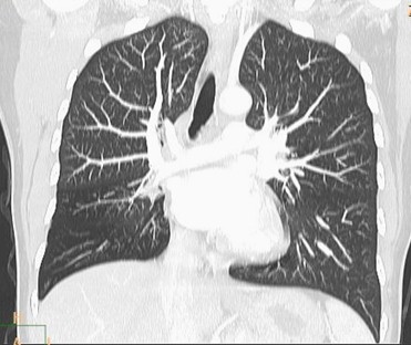 sindrome_Swyer-James/hipoplasia_arteria_lobar