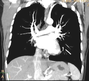 sindrome_Swyer-James/mediastino_hipoplasia_arterial