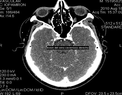 sindrome_Tolosa-Hunt/TAC_craneal_cavernoso