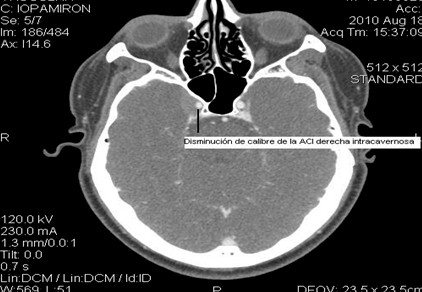 sindrome_Tolosa-Hunt/disminucion_calibre_arteria