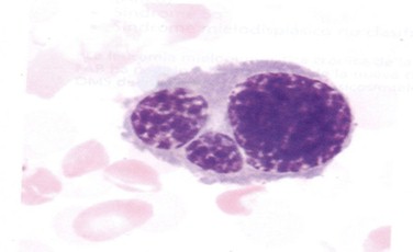 sindrome_mielodisplasico_mielodisplasia/diseritropoyesis_precursor_eritrocitico sindrome_mielodisplasico_mielodisplasia/diseritropoyesis_precursor_eritrocitico