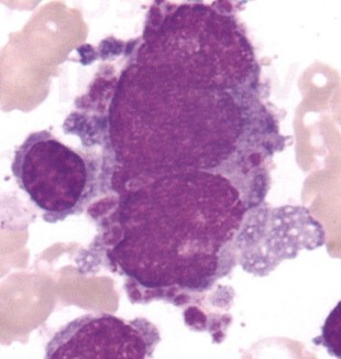 sindrome_mielodisplasico_mielodisplasia/dismegacariopoyesis_megacariocito_plaquetas sindrome_mielodisplasico_mielodisplasia/dismegacariopoyesis_megacariocito_plaquetas
