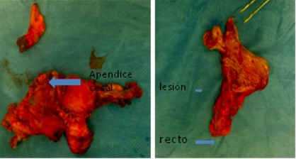 teratoma_maduro_ovario/histerectomia_tumor_ovarico