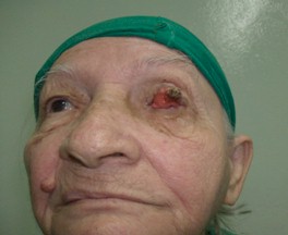 tumor_palpebral_caso/lesion_ulcerosa_parpado