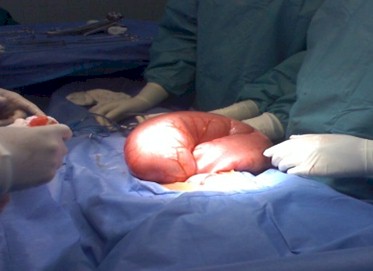volvulo_sigmoides_caso/cirugia_reseccion_sigmoides volvulo_sigmoides_caso/cirugia_reseccion_sigmoides