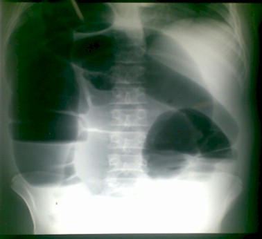volvulo_sigmoides_caso/radiografia_signo_omega volvulo_sigmoides_caso/radiografia_signo_omega