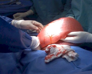 volvulo_sigmoides_caso/tratamiento_quirurgico_cirugia
