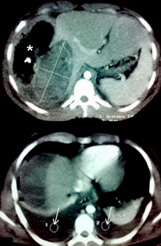 hemangioma_hepatico_gigante/TAC_angioma_higado