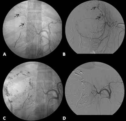 hemangioma_hepatico_gigante/arteriografia_celiaca_selectiva