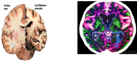 Alzheimer_enfermedad_demencia/lesiones_cerebrales_cerebro