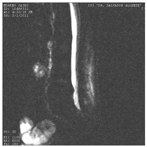 Discitis_Resonancia_Magnetica_RMN/foto_de_mielografia Discitis_Resonancia_Magnetica_RMN/foto_de_mielografia