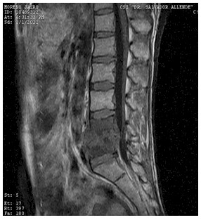 Discitis_Resonancia_Magnetica_RMN/secuencias_t1_sagitales