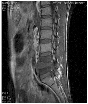 Discitis_Resonancia_Magnetica_RMN/secuencias_t1_sagitales3