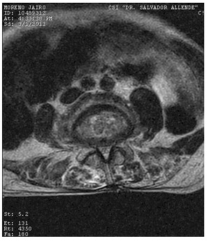 Discitis_Resonancia_Magnetica_RMN/secuencias_t2_axiales3