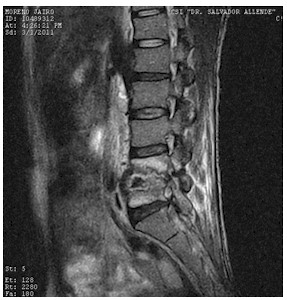 Discitis_Resonancia_Magnetica_RMN/secuencias_t2_sagitales Discitis_Resonancia_Magnetica_RMN/secuencias_t2_sagitales