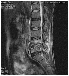 Discitis_Resonancia_Magnetica_RMN/secuencias_t2_sagitales2