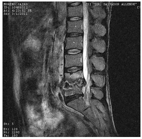 Discitis_Resonancia_Magnetica_RMN/secuencias_t2_sagitales3