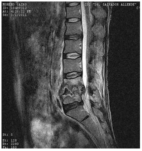 Discitis_Resonancia_Magnetica_RMN/secuencias_t2_sagitales4