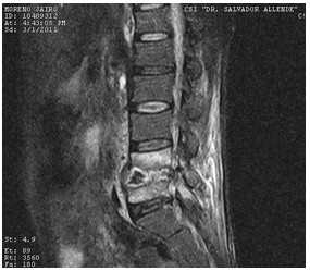 Discitis_Resonancia_Magnetica_RMN/secuencias_tirm_sagitales2