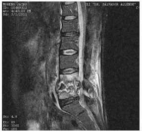 Discitis_Resonancia_Magnetica_RMN/secuencias_tirm_sagitales3