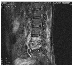 Discitis_Resonancia_Magnetica_RMN/secuencias_tirm_sagitales4