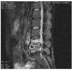 Discitis_Resonancia_Magnetica_RMN/secuencias_tirm_sagitales5