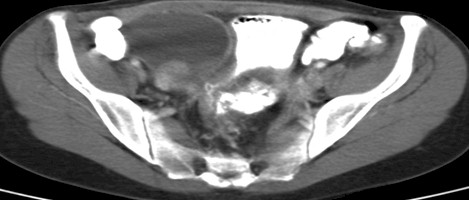 fistula_entero-uterina/transito_intestino_delgado fistula_entero-uterina/transito_intestino_delgado
