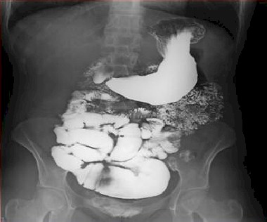 fistula_entero-uterina/absceso_retrouterino_Douglas fistula_entero-uterina/absceso_retrouterino_Douglas