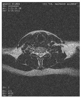 hidrocefalia_congenita_RMN/cervical_t2_axiales1 hidrocefalia_congenita_RMN/cervical_t2_axiales1