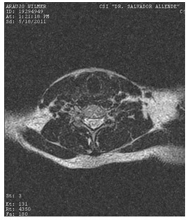 hidrocefalia_congenita_RMN/cervical_t2_axiales2 hidrocefalia_congenita_RMN/cervical_t2_axiales2