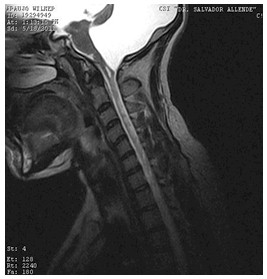 hidrocefalia_congenita_RMN/columna_cervical1_t2