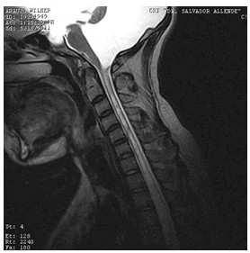 hidrocefalia_congenita_RMN/columna_cervical2_t2