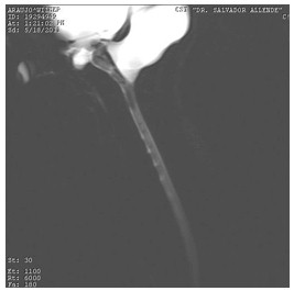 hidrocefalia_congenita_RMN/columna_cervical_mielografia