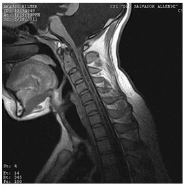 hidrocefalia_congenita_RMN/columna_cervical_t1