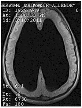 hidrocefalia_congenita_RMN/flair_secuencias_axiales4