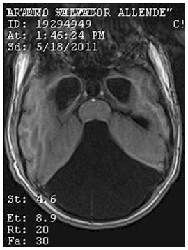 hidrocefalia_congenita_RMN/t1_secuencias_axiales3
