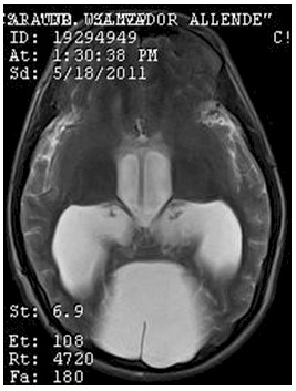 hidrocefalia_congenita_RMN/t2_secuencias_axiales1