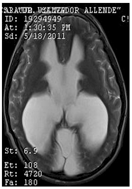 hidrocefalia_congenita_RMN/t2_secuencias_axiales2