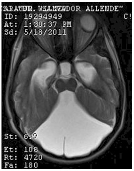 hidrocefalia_congenita_RMN/t2_secuencias_axiales3