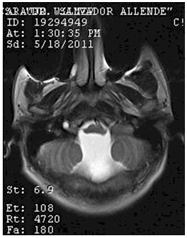 hidrocefalia_congenita_RMN/t2_secuencias_axiales4