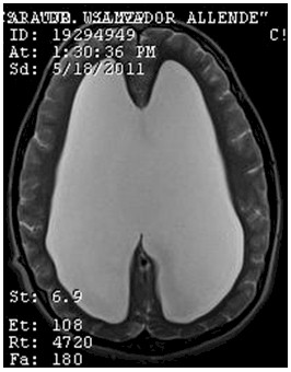 hidrocefalia_congenita_RMN/t2_secuencias_axiales5