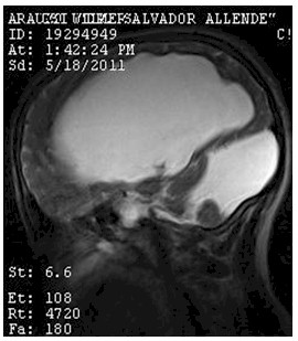 hidrocefalia_congenita_RMN/t2_secuencias_sagitales2