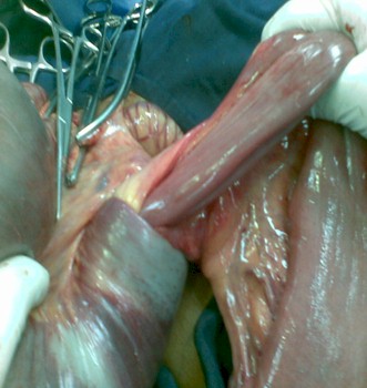 intususcepcion_intestinal_polipo/cirugia_tratamiento_quirurgico