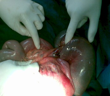 intususcepcion_intestinal_polipo/ileon_invaginado_cirugia